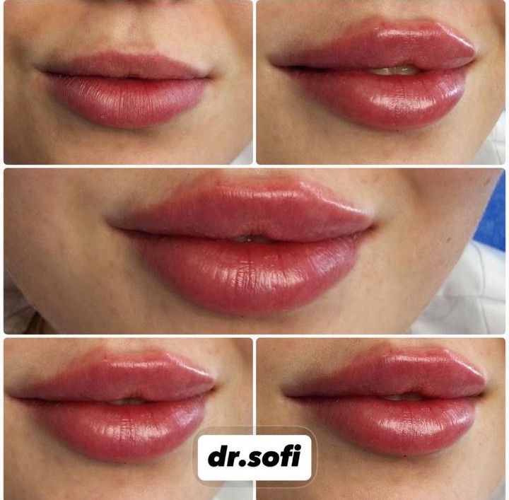 ტუჩის აუგმენტაცია